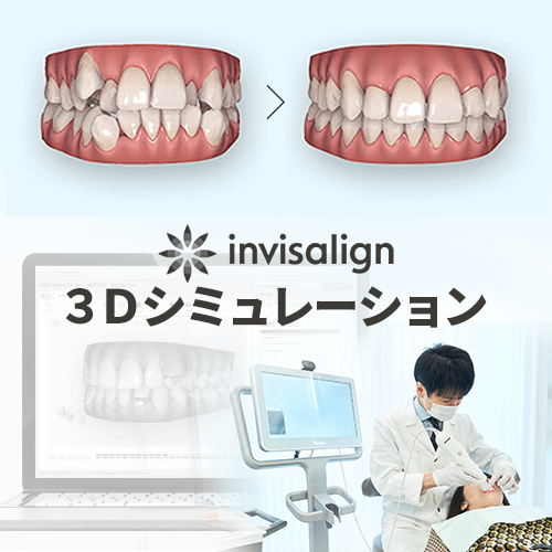歯並びの3Dシミュレーション